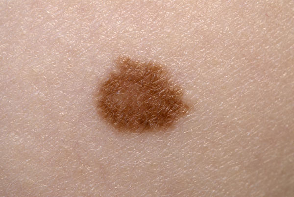 Funcionarios UC previenen el melanoma